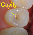 Cavities | Palm Beach County, Boynton Beach, West Palm Beach, Boca ...