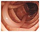 Ascariasis — NEJM