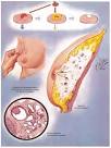 <b>Enfermedad fibroquística</b>