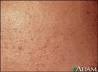 Acne Cosmetica - What is Acne Cosmetica