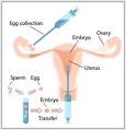 Couple's Infertility – Management And Treatment