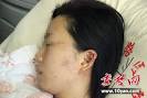 图为程婷在医院接受治疗