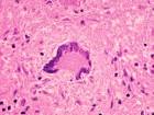 Giant multinucleated cells