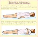 Decerebrate posture. Causes, symptoms, treatment Decerebrate posture