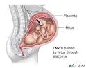 Congenital Cytomegalovirus :: Nationwide Children's Hospital