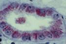 The Nephrotic Syndrome