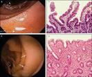 Celiac Disease - December 15, 2007 - American Family Physician