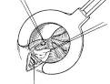 Thrombosed Hemorrhoid | Unbounded Medicine