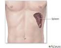 <b>Hiperesplenismo</b>. Para imprimir. Imagen anteriorAmpliarCerrarSiguiente imagen
