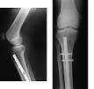 Bone fracture - Wikipedia, the free encyclopedia