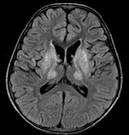 known as <b>hepatolenticular</b>