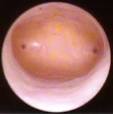 Hysteroscopy for Infertility