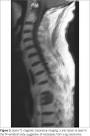 (<b>Tc</b>-<b>99m</b> MDP) by injection,