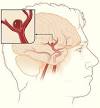 Brain Aneurysm: MedlinePlus