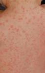 http://upload.wikimedia.org/wikipedia/commons/7/73/Amoxicillin_rash_3_hours_after_17th_dose.JPG