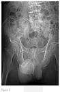 <b>espermatocele</b> calcificado