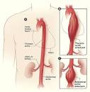 Aortic Aneurysms