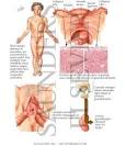 <b>Gonadal Dysgenesis</b> - Netter Medical Images