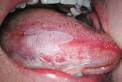 ScienceDirect.com - Revue de Stomatologie et de Chirurgie Maxillo