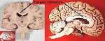 File:<b>Corpus callosum</b>.jpg