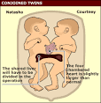 Siamese twins share heart