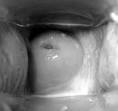 Inflamed Cervix - a comprehensive view - Wellsphere