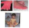 <b>Acrodynia</b> (Swift's disease/