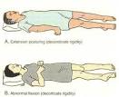 Pathophysiology Neuro