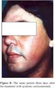 Treatment uses topical or