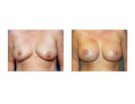 Explore Plastic Surgery   Dr Barry Eppley    need for nipple lifts