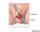  Circumcision why do we still think it's okay
