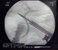 Cholecystectomy - Wikipedia, the free encyclopedia