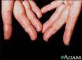 Amyloidosis on the fingers Image - Medical Information