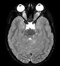 NF1-Bilateral <b>optic nerve</b>