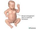 Hormonal Effects in Newborns :: Nationwide Children's Hospital