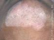 Vitiligo Nedir Nasıl Tedavi Edilir-Vitiligonun Doğal Bitkisel ...
