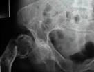 <b>fibrous dysplasia</b>