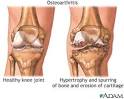 <b>Osteoarthritis</b> is a chronic