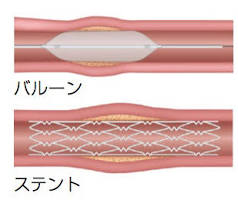 狭心症・心筋梗塞の カテーテル治療 PCI | 兵庫県立尼崎総合医療 ...