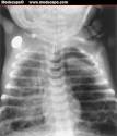 <b>Meconium Aspiration Syndrome</b>: