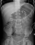 Medullary <b>nephrocalcinosis</b>