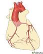 Angioplasty: MedlinePlus