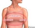 Breast pain
