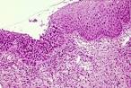 What's the connection between dysplasia and neoplasia?
