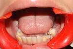 <b>Dentin dysplasia</b> type I: a