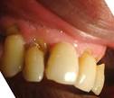 <b>Erosión dentaria</b> en vestibular