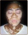 How To Cure VitiligoFast   The  1 Resource For Vitiligo Treatments