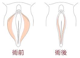 女性性器整形|湘南美容外科