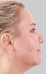 No Surgery Liposuction   Exilis Body Shaping in Las Vegas