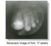 diagnosed via <b>fetoscopy</b>